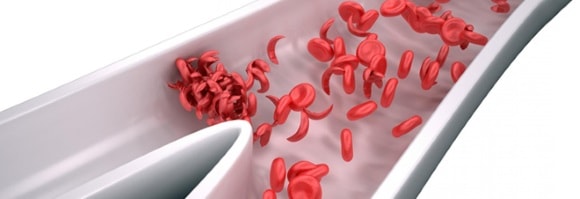 Густая кровь - причины, симптомы у женщин, лечение