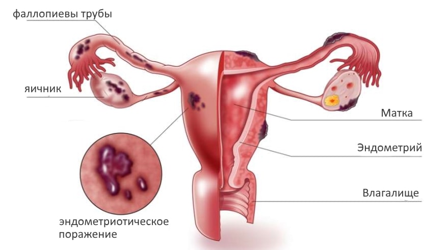 Лечение эндометриоза у женщин после 40 лет