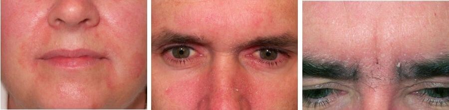 Себорейный дерматит на лице: фото, лечение, мази