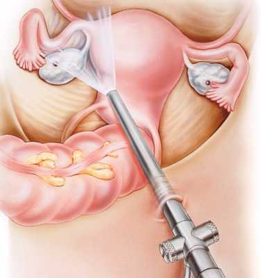 Лапароскопия при внематочной беременности - как проходит